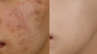 하루사이에 피부가 이렇게됐습니다.. 피부 트러블 두껍지않게 완벽 커버 메이크업