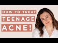How To Treat Teen Acne Dr Sam Bunting