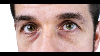 Dark circles under eyes men: how do I get rid of dark circles under eyes?