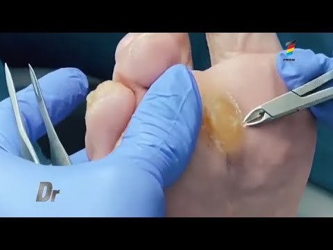 Cum să vindeci ciuperca unghiilor cu peroxid