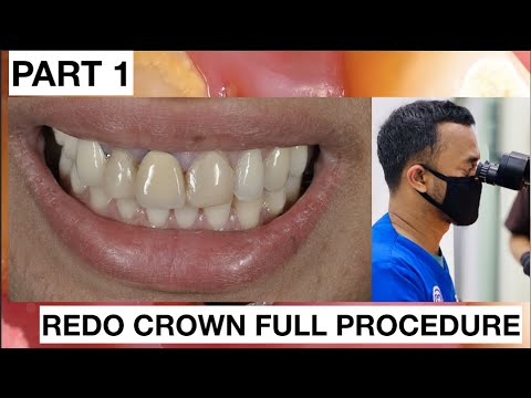 Step by Step Redo Dental Crown. Part 1