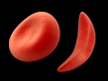 Two Additional Complications in Sickle Cell Anemia ...