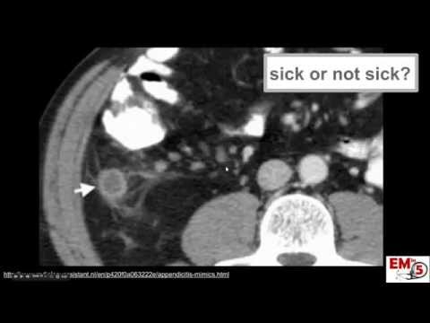 CT Imaging: Appendicitis