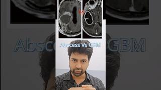 Brain abscess Vs Glioblastoma multiforme. Ring enhancing lesions on MRI. #brainabscess #neurosurgery