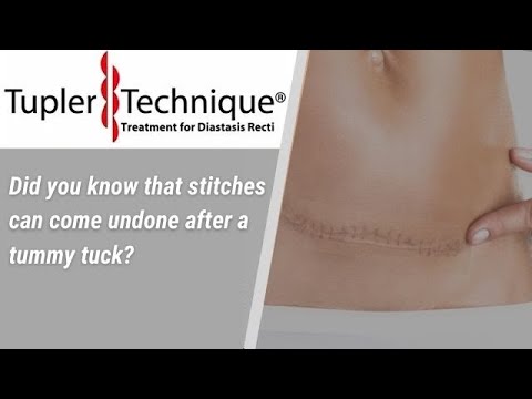 Did you know that stitches can come undone after a tummy tuck?