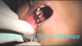 preview picture of video 'TUBEROSITY IMPLANTS VaRam Advanced Implants Dental Clinic'