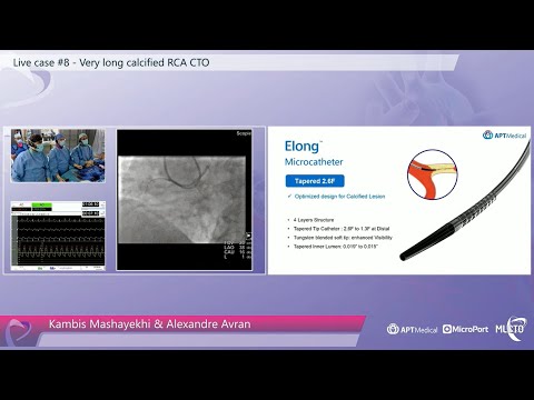 Very long calcified RCA CTO - MLCTO 2022