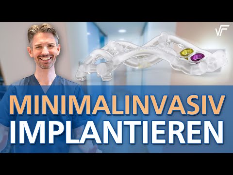 Zahnimplantate ohne große OP? Machbar dank 3D Schablone!