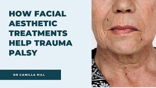 DID YOU KNOW THAT FACIAL AESTHETIC TREATMENTS CAN HELP WITH TRAUMA PALSY | Dr Camilla Hill