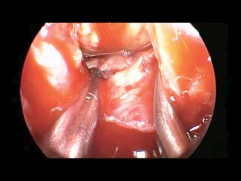 Injury of Head Followed by Hemorrhage from Pituitary Cyst