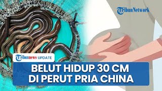 Pria di China Alami Sakit Perut Hebat hingga Keras, Ditemukan Belut Hidup Sepanjang 30 Cm di Usus