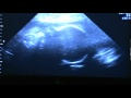 Ultrasound Week 30 Video