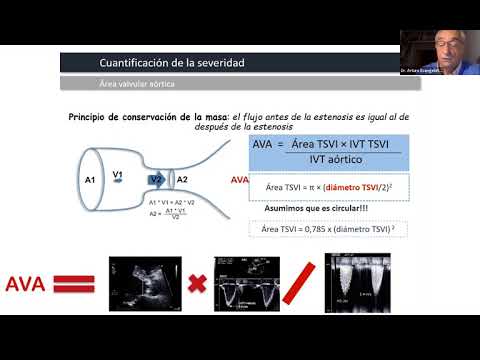 Webinar FAC - Valvulopatías. Estado del arte en Diagnóstico y Tratamiento 2021