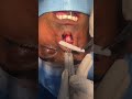 Redo Nose Surgery Where The Earlier Placed Silicon Implant Is Being Removed