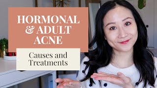 Treating Hormonal Acne | Dermatologist Tips