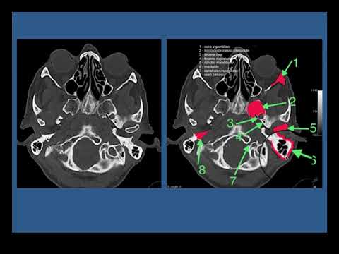 TOMOGRAFIA BASE DO CRANIO - 2