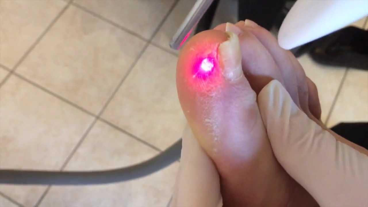 MYCOSE ONGLES PIEDS traitée au Laser