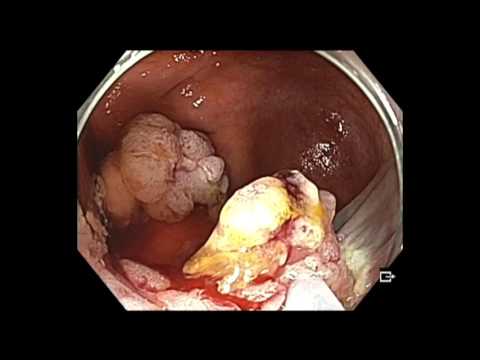 Colonoscopy: IC Valve Lesion Resection