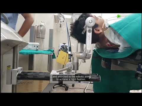 Minimally Invasive Robotic Disconnection of Delalande Type III Hypothalamic Hamartoma