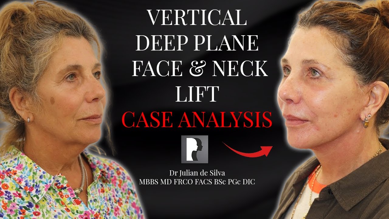 60 Year old looks 20 years younger with this INCREDIBLE Facelift Transformation!