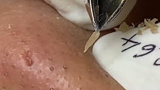 Download Lagu relax,Satisfying,nose blackheads,tweezers,acne treatment,鼻角栓,ピンセット,피지제거 027 Thumbnail
