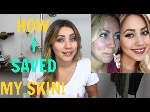 抗痘大作戰!如何擊敗粉刺 (How I Beat My Acne | Oil Cleansing Method)