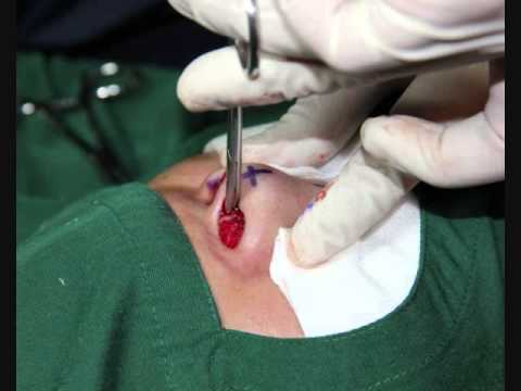 Noselift or Augmentation Rhinoplasty for Asians