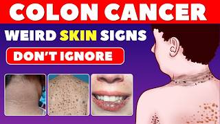 8 Weird Skin Symptoms Linked to Colon Cancer