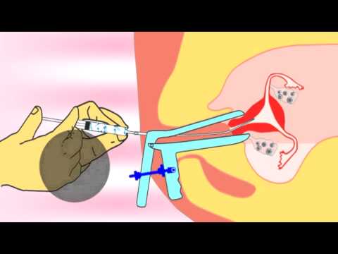 Intrauterine insemination-iui, iutpi, the new method of inse...