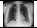 Chest x-ray - Heart failure, Kerly B lines ...