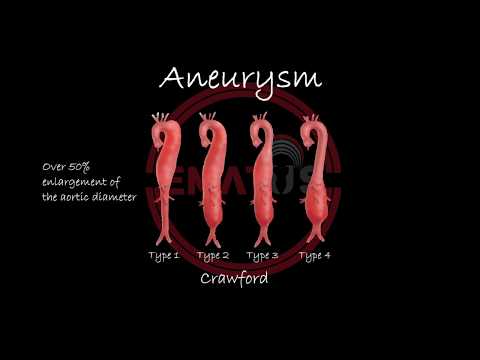 Point of Care Ultrasound for the Aortic Pathologies