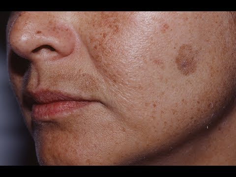 Из за чего на ногах пигментные пятна Средство для отбеливания лица от веснушек