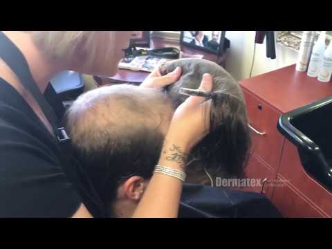 Spencers Hair Restoration Transformation | Dermatex...