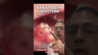 What to Do if Your Child Has a PAINFUL Tooth Infection | View Mobile Dental #shorts