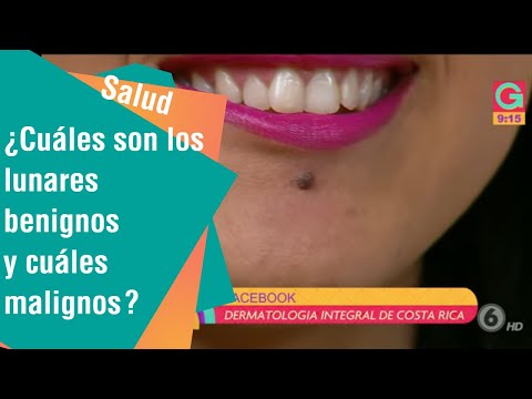 download lagu mp3 mp4 Lunares Benignos, download lagu Lunares Benignos gratis, unduh video klip Download Lunares Benignos Mp3 dan Mp4 320kbps Gratis