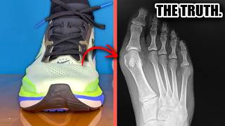 The Bizarre Truth About Tight Shoes & Bunions