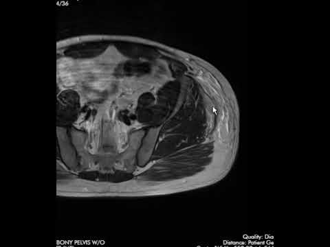 Tensor fasciae latae muscles rupture