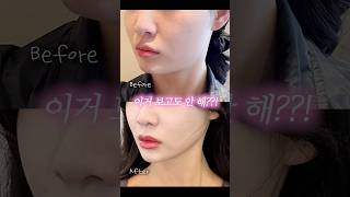 V라인 리프팅 1티어 울쎄라 찐 후기⚡