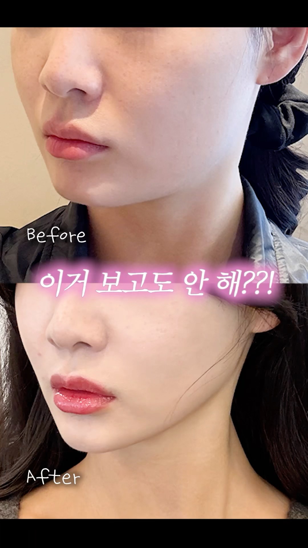 V라인 리프팅 1티어 울쎄라 찐 후기⚡