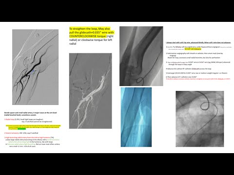 Radial loops- Difficult radial, subclavian and aortic anatomy: step-by-step, cases, perforation