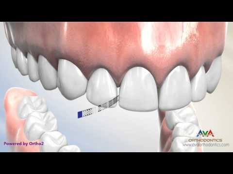 Interproximal Reduction or IPR - Polishing Strip
