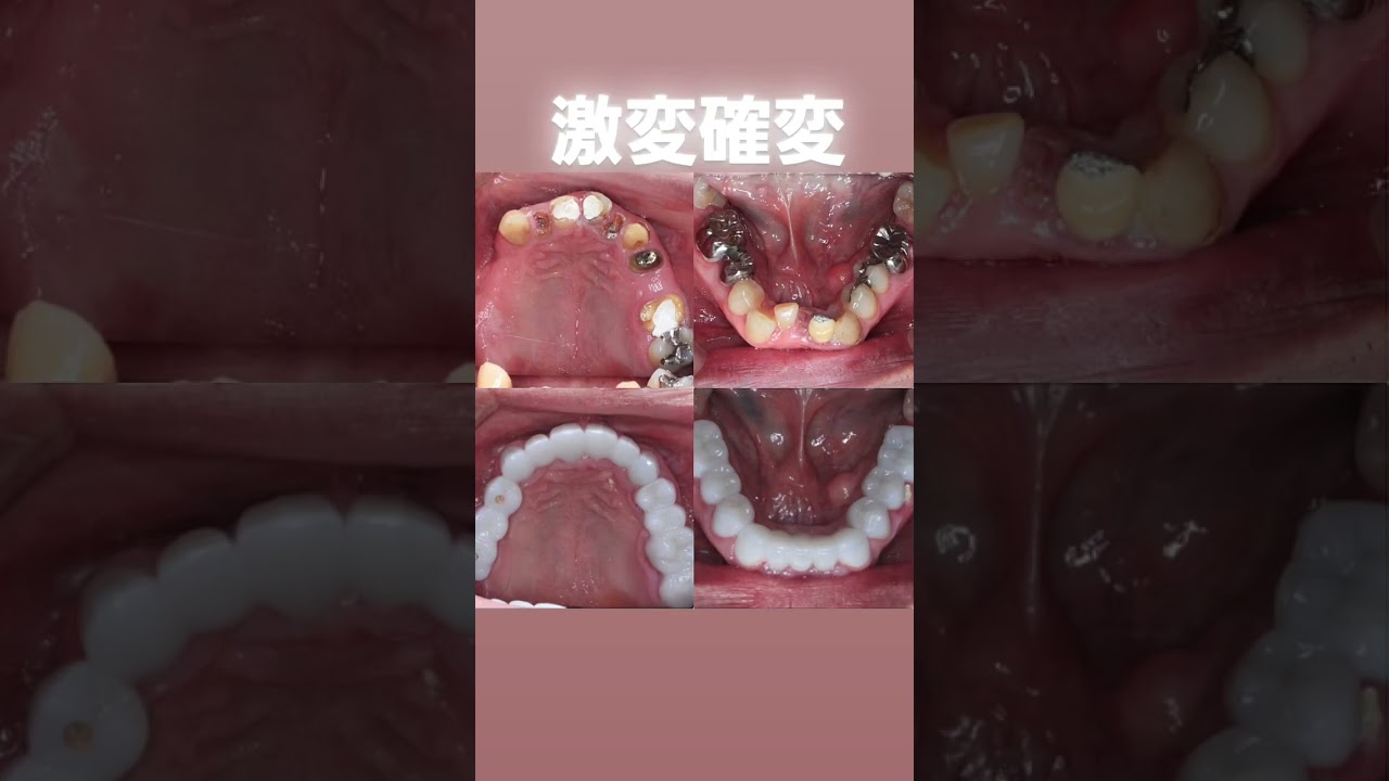 全24歯今クリアートダイヤモンドセラミック、インプラント２本併用です。全てをイチから再構築して、なお最も美しくを追求していきました。#セラミック#インプラント#ダイヤモンド今井院長