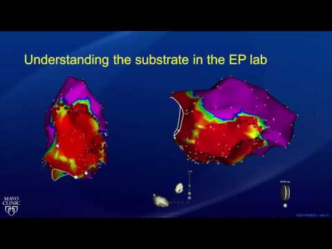 Ablation: Treatment for Ventricular Tachycardia - Part 2