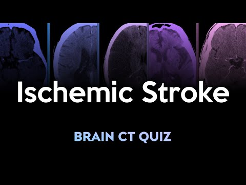 Ischemic Stroke: Brain CT Quiz