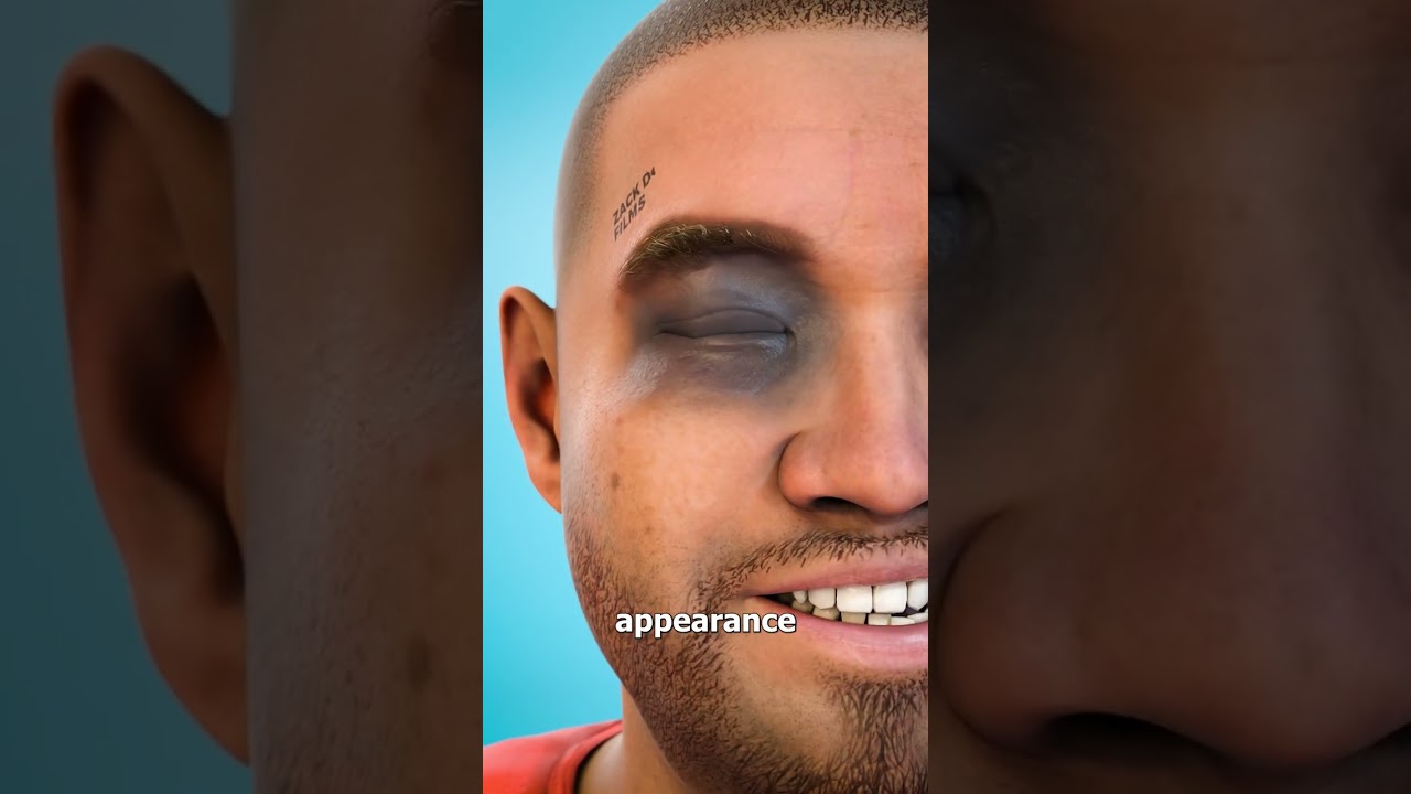 What Is A Black Eye? 🤔