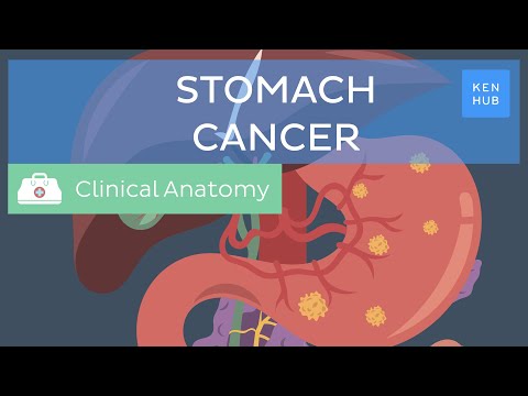 Stomach cancer: Definition, causes, symptoms and treatment | Kenhub