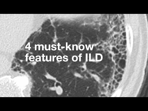 4 Must-Know Features of ILD