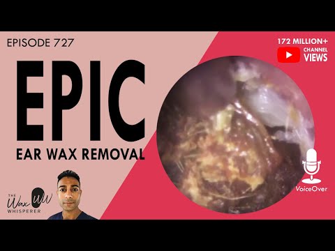 727 - Epic Ear Wax Removal