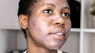 MY UNIQUE CHEMICAL PEEL JOURNEY