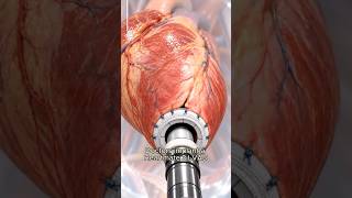 How This Machine Supports the Heart